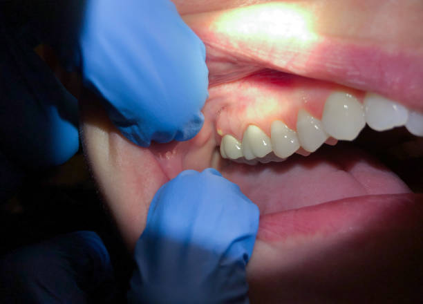 Best Emergency Root Canal Treatment in Lacon, IL