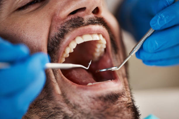 Best Emergency Dental Extractions in Lacon, IL